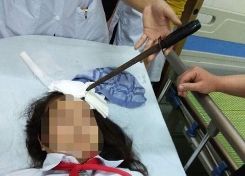 Nữ sinh được đưa vào bệnh viện cấp cứu trong tình trạng con dao vẫn bị cắm trên đầu. Ảnh: Báo Hà Nam