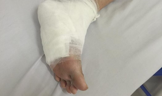 Bàn chân bệnh nhân P bị bỏng nặng sau khi dùng sưởi đá muối Himalaya 