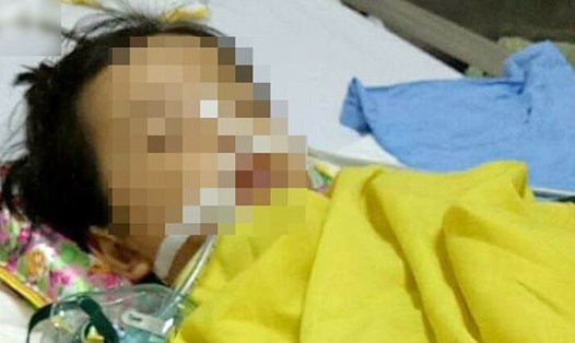 Bé gái 20 tháng tuổi bị rạn não sau 3 ngày đến trường.