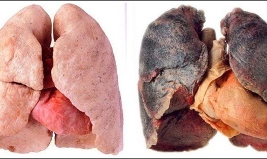 Thuốc lá gây ung thư phổi
