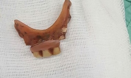 Hàm răng giả nằm trong thực quản của bệnh nhân T. Ảnh: BVCC