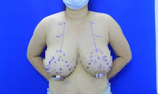 Hình ảnh bộ ngực khổng lồ do bị phì đại tuyến vú. Ảnh: BVCC