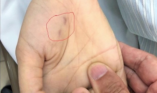 Vết chó cắn trên bàn tay bệnh nhân sau 1,5 tháng (Ảnh: BVCC)