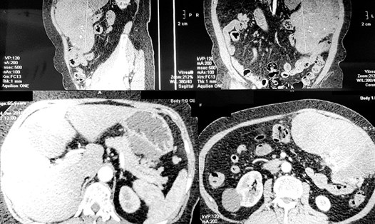 CT Scan- hình ảnh khối bướu rất lớn trong ổ bụng.