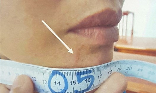 Sẹo ở vết thương phần mềm cằm phải của bà Nguyễn Thị Thu Hương có tỉ lệ thương tật 12%(?). Ảnh: P.V
