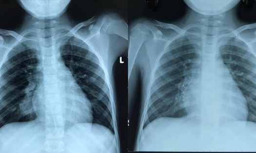 Hình ảnh chụp X-quang phần ngực của bệnh nhi trước và sau khi tiến hành thông tim can thiệp đóng túi phình bằng dụng cụ