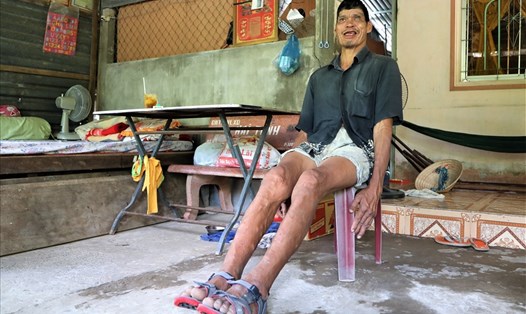 Người khổng lồ Nguyễn Văn Y đang bị bệnh và đối diện với một tương lai mịt mờ. Ảnh: Trường Sơn