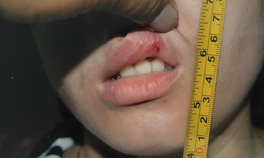 Vết bầm ở miệng chị L.A sau khi bị nam đồng nghiệp "dùng miệng hôn" Ảnh: LĐO