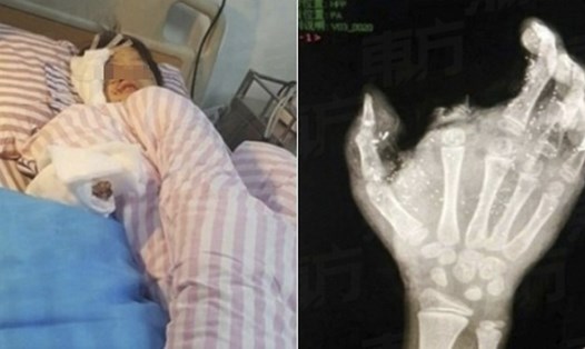 Bé Meng Jisu mất mắt trái và cụt ngón giữa tay phải.