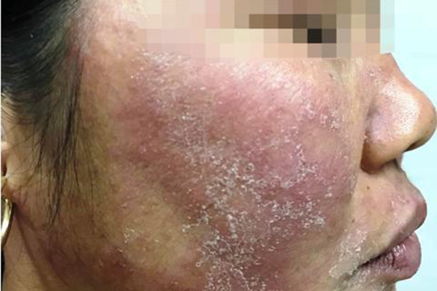 Khuôn mặt tan nát sau khi sử dụng kem trộn không rõ nguồn gốc (ảnh phải). Ảnh: BSCC