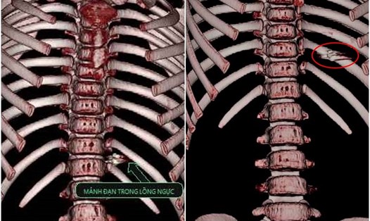 Hình ảnh chụp 3D lồng ngực xác định chính xác vị trí mảnh đạn găm trong lồng ngực bệnh nhi.