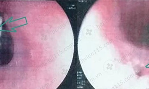 Hình ảnh nội soi thực quản của bệnh nhân: mảnh xương gà (trái) và lỗ thủng thực quản sau khi gắp xương gà ra (phải) Ảnh: BVCC.