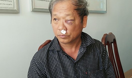 Nhà báo Hoàng Đình Chiểu bị đánh sưng mặt. Ảnh Phúc Nguyên