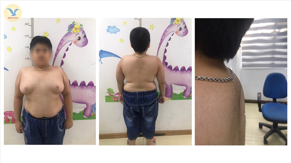 Bé trai bị béo phì do lạm dụng corticoid. Ảnh: BSCC