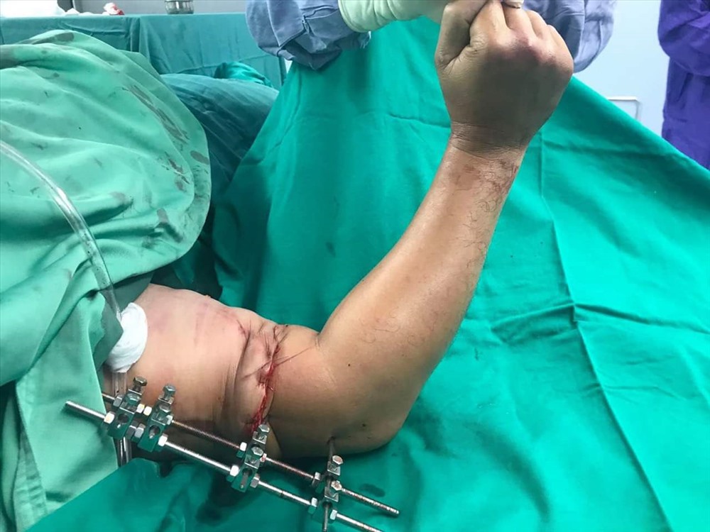 Bệnh nhân N được các bác sĩ Bệnh viện Trung ương Quân đội 108 nối thành công cánh tay đứt lìa.