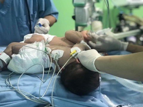 Ca phẫu tách 2 bé gái song sinh dính nhau. Ảnh: BVCC