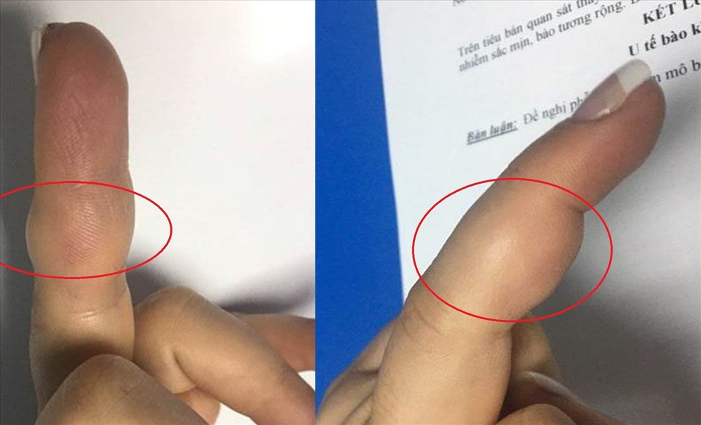 Ngón tay chỉ sưng to nhưng xét nghiệm cho thấy bệnh nhân mắc phải u tế bào khổng lồ. Ảnh: BSCC