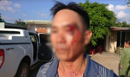 Ông Hôm bị đánh rách mặt sau khi tố cáo cán bộ địa chính xã Cư Elang nhận hối lộ. Ảnh: LX