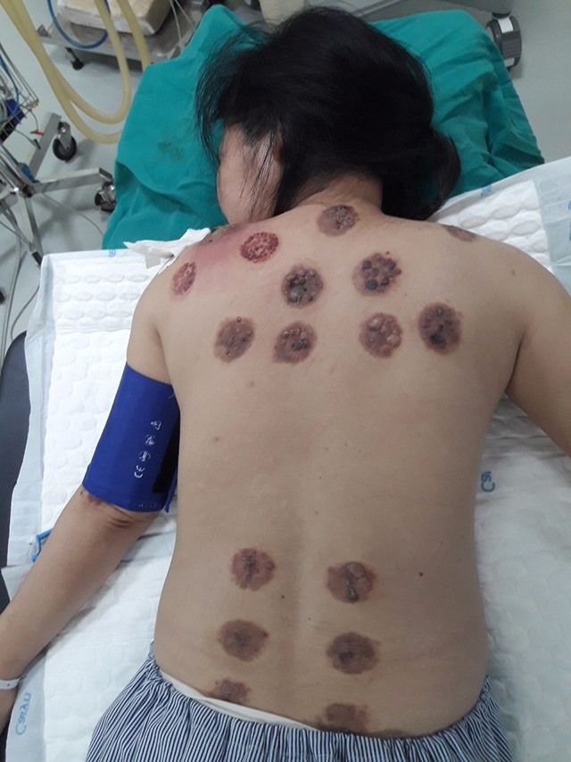 Vùng da tổn thương do giác hơi phải điều trị dài ngày.