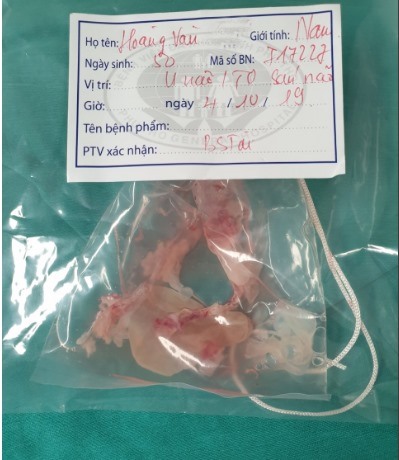 Ổ sán được lấy ra. Ảnh do BV cung cấp.