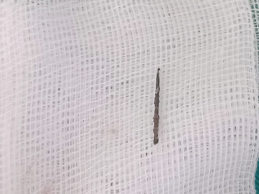 Dị vật kim khâu được lấy ra từ người bệnh. Ảnh do BV cung cấp.