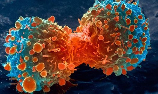 Ung thư có thể tái phát vì trong cơ thể vẫn tồn tại các tế bào ung thư "ngủ đông". Ảnh: Getty Images