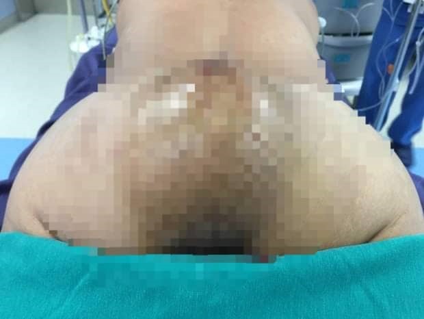 Khối u có kích thước khổng lồ hành hạ bệnh nhân nhiều năm. Ảnh: BSCC