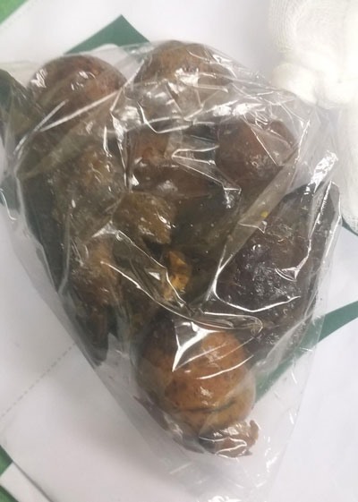 Khối cục bã thức ăn toàn là hạt xoài, quả chanh leo, đồng xu trong dạ dày của người bệnh