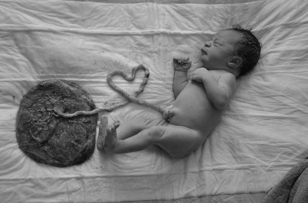 Sản phụ sinh con tại nhà, không cắt dây rốn, để nhau thai khô. Ảnh minh họa