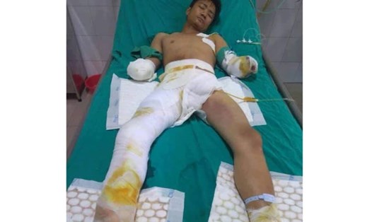 Anh Hà Văn Cường chỉ còn một chân trái bị bỏng nặng đang tiếp tục điều trị tại Viện Bỏng Quốc gia. Ảnh: NVT