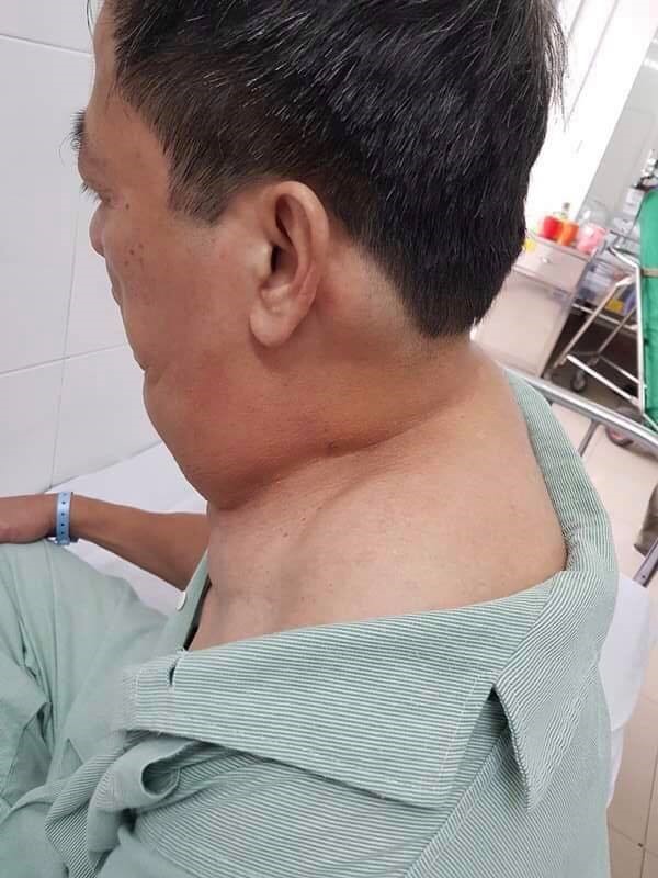 U mỡ “khủng” nổi vòng quanh cổ người đàn ông nghiện rượu