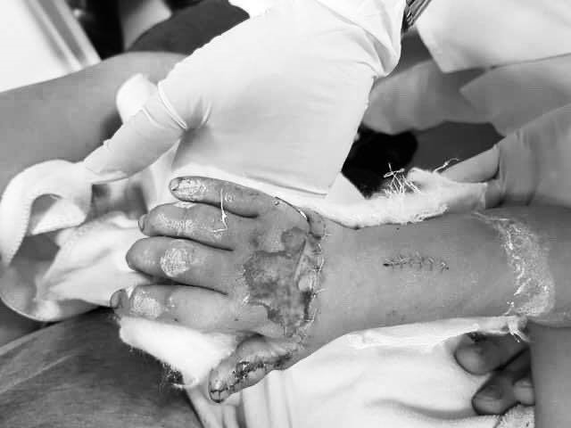 Bàn tay của bệnh nhi đã ấm hồng, cử động được.