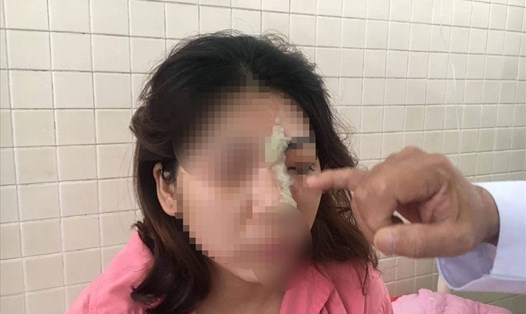 Cô gái bị mù mắt trái sau khi tiêm filler nâng mũi. Ảnh: BVCC