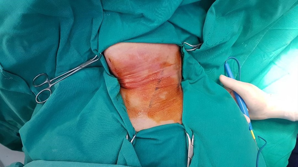 Hình ảnh tổn thương của bệnh nhân. Ảnh: BVCC