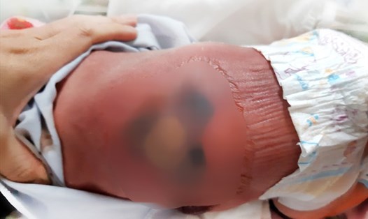 Trẻ sơ sinh bị bỏng nặng do nằm hơ than