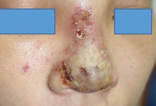 Tiêm chất làm đầy để làm đẹp, khách hàng nhận hậu quả.