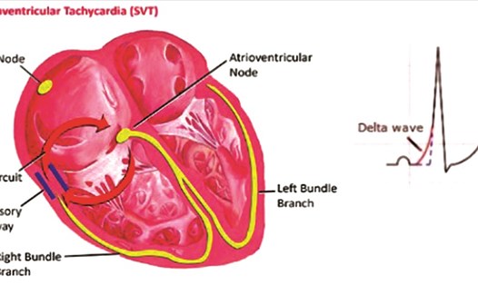 Mô hình mô phỏng hội chứng Wolff-Parkinson-White - một dạng loạn nhịp tim có thể dẫn đến đột tử nếu không điều trị kịp thời.