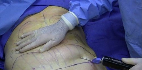 Một ca hút mỡ bụng ở nam giới. Ảnh tư liệu: BSCC