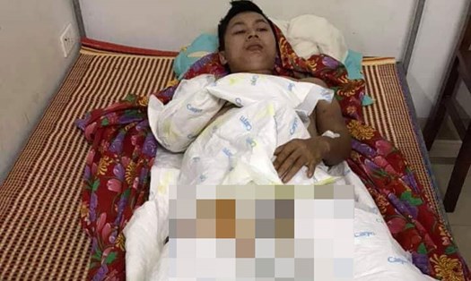 Anh Vũ Văn Tân bị bỏng toàn thân, đang được điều trị tại Hà Nội. Ảnh: TP