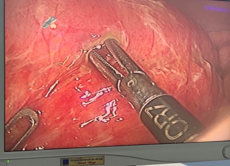 Hình ảnh lỗ thủng trên ruột non.