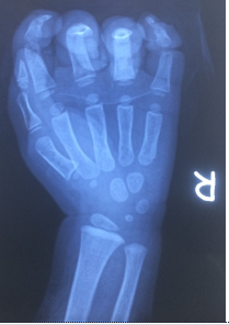 Hình ảnh bàn tay bị đa chấn thương.