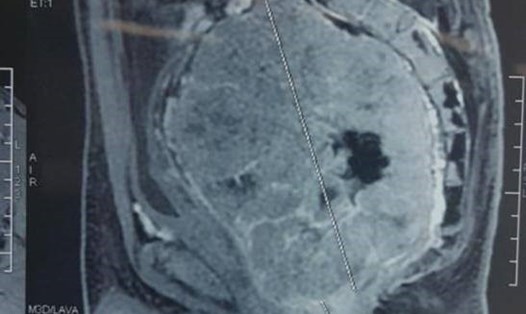 Hình ảnh chụp cắt lớp từ khối u của bệnh nhân