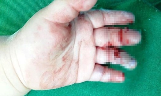 Nhiều ngón tay của bệnh nhi bị dập nát. Ảnh: PV.