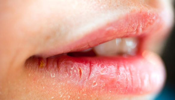 8 cách chữa khô nứt môi hiệu quả cho đôi môi luôn căng mọng
