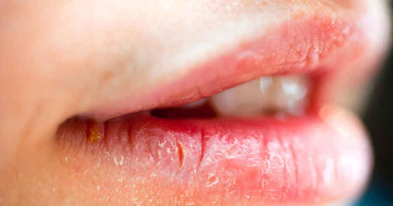 8 cách chữa khô nứt môi hiệu quả cho đôi môi luôn căng mọng