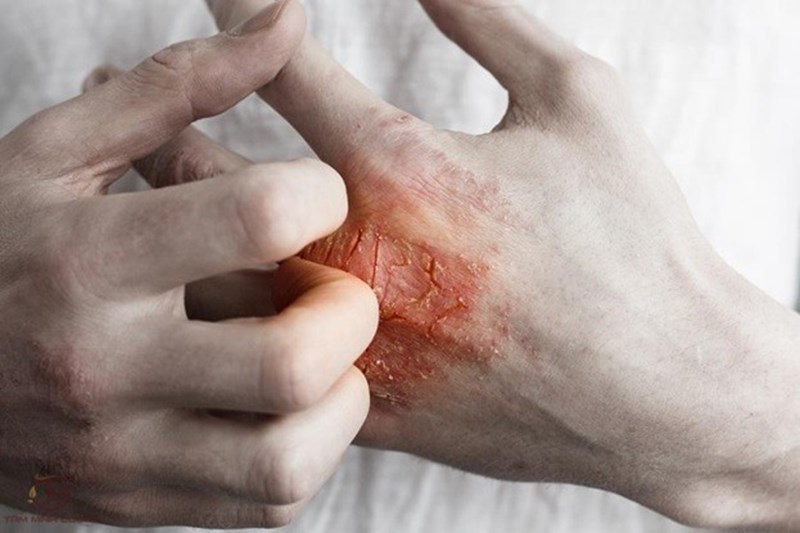 Bệnh chàm eczema có liên quan đến di truyền không?
