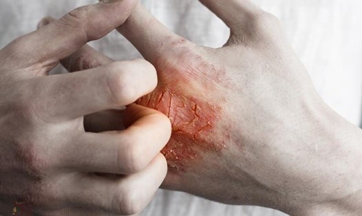 Hình ảnh người bệnh bị chàm - eczema (Ảnh minh họa)