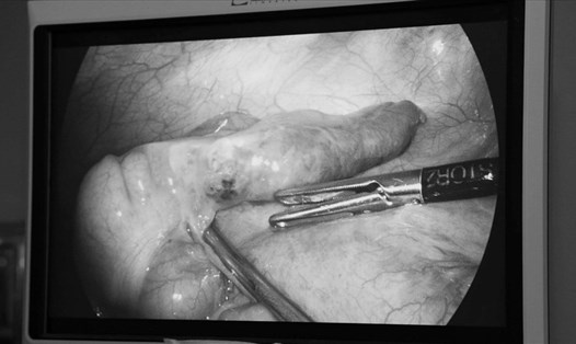 Hình ảnh gắp dị vật trong bụng bệnh nhân. Ảnh: BVCC.
