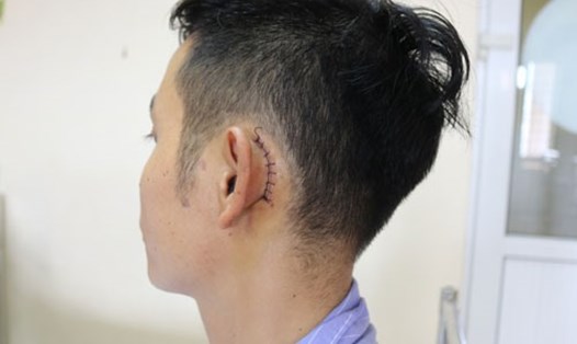 Phần tai trái bị tổn thương của người bệnh sau phẫu thuật.