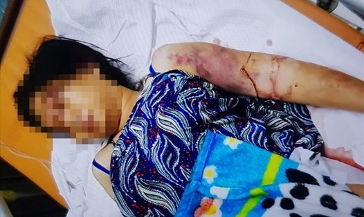 Thai phụ 18 tuổi bị tra tấn đến sẩy thai phải điều trị trong bệnh viện.
